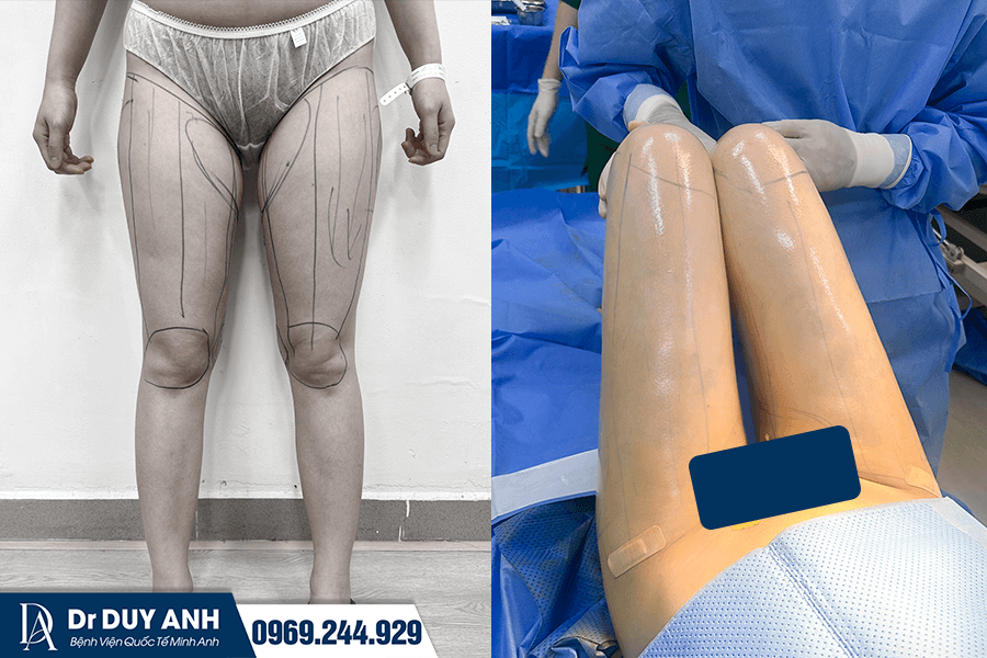 Hút Mỡ Đùi Là Gì? Có An Toàn Không? Chi Phí Bao Nhiêu 2026?