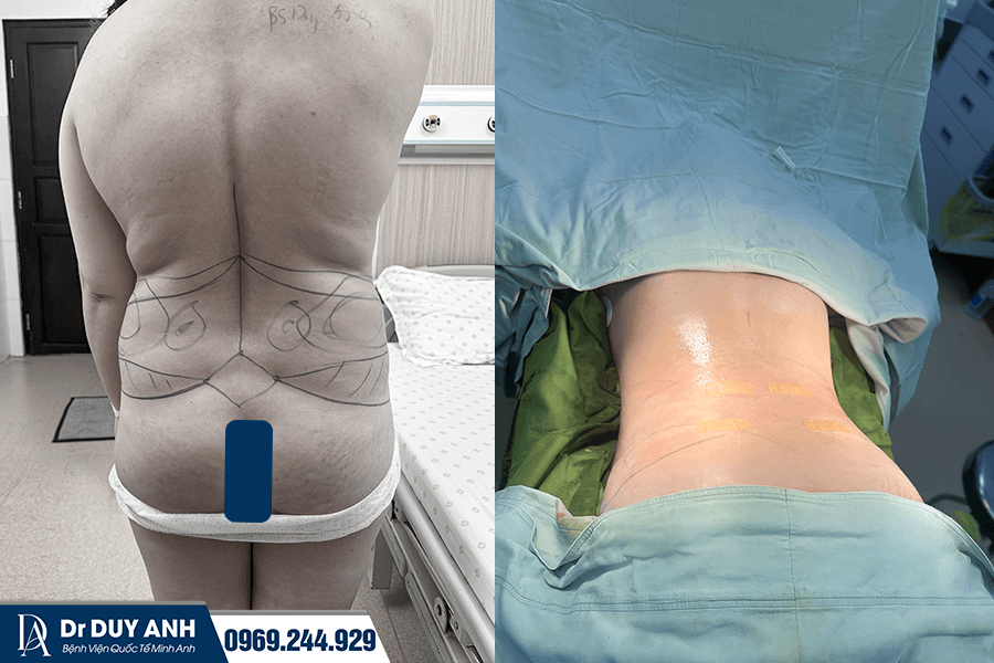 Hút Mỡ Hông Eo Là Gì? Có An Toàn Không? Chi Phí Bao Nhiêu 2026?