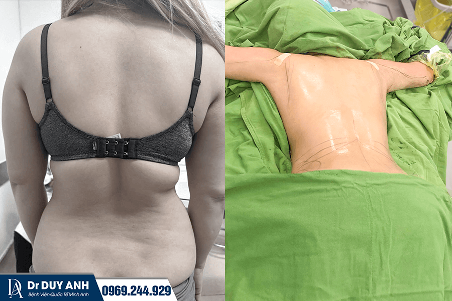 Hút Mỡ Lưng Là Gì? Có An Toàn Không? Chi Phí Bao Nhiêu 2026?