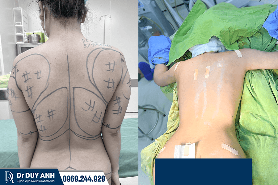 Hút Mỡ Nách Là Gì? Có An Toàn Không? Chi Phí Bao Nhiêu 2026?