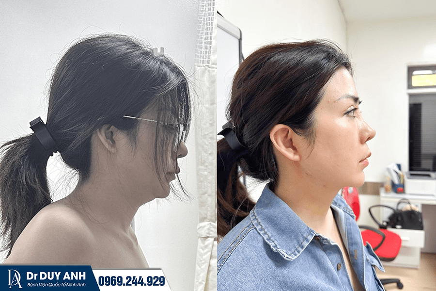 Hút Mỡ Nọng Cằm Là Gì? Có An Toàn Không? Chi Phí Bao Nhiêu 2026?