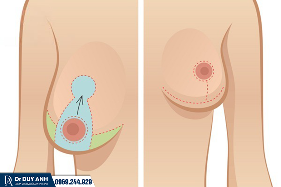 Treo Ngực Sa Trễ Đường Mỏ Neo Là Gì? Có Để Lại Sẹo Không? Chi Phí Bao Nhiêu?