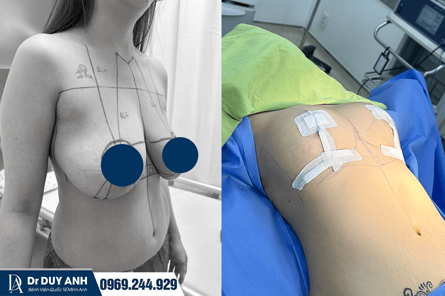 Treo Ngực Sa Trễ Là Gì? Các Cấp Độ Treo Ngực Sa Trễ? Chi Phí Bao Nhiêu 2026?