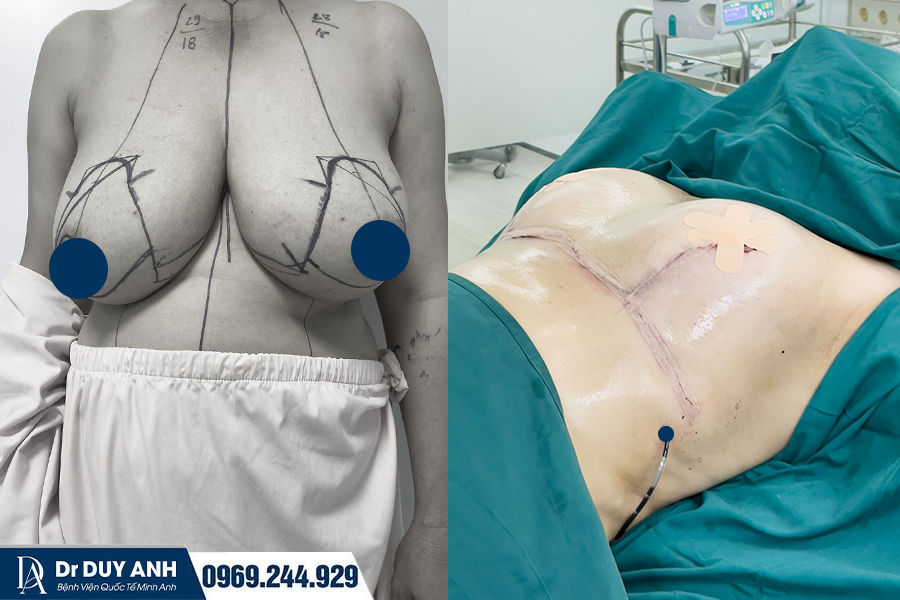 Treo Sa Trễ Không Đặt Túi - Giải Pháp Căng Tròn Tự Nhiên Cho Vòng 1